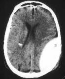 Epidurales_Haematom.jpg