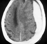 Subdurales_Haematom.jpg